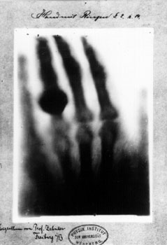 primeira radiografia, obrida por Wilhelm Röntgen, usando radiação X, a partir da mão da sua esposa em 1895