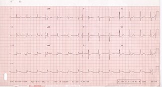 Eletrocardiograma de 12 derivações (ECG) com elevação do segmento ST nas derivações II, III e aVF, sugestivos de infarto agudo do miocárdio inferior (AMI).