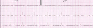 Eletrocardiograma de um homem saudável, 21 anos